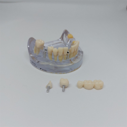 Implantat/Bro Studiemodel 